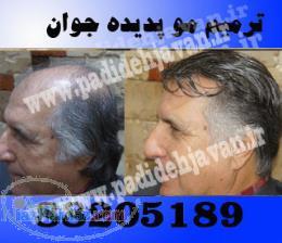 ترمیم مو جایگزین کاشت مو (پدیده جوان)