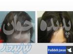 کاشت موی باتوان بدون جراحی ، روش کاشت مو در بانوان
