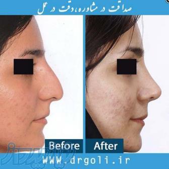 جراحی زیبایی بینی