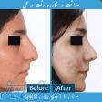 جراحی زیبایی بینی