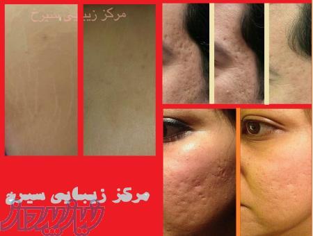 سیرخ (درمان ترک پوستی،رفع جای جوش،رفع اسکار )(100 تضمینی)
