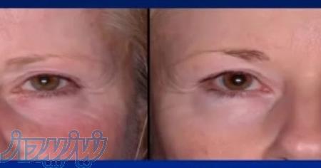 هایفوتراپی و لیفتینگ و جوان سازی پوست با هایفو ایتالیایی 