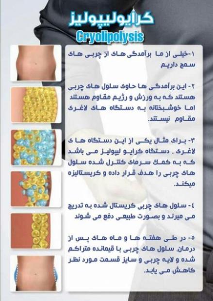 لاغری موضعی با کرایولیپولیز در یک جلسه زیرنظر پزشک  - تهران