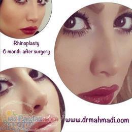 جراح بینی با بیش از 30 سال تجربه dr mehdi ahmadi