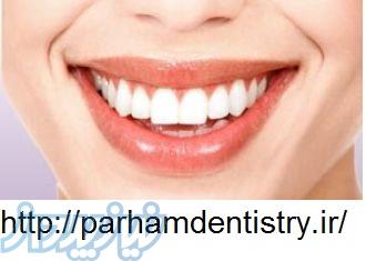 لامینت دندان های خود را زیبا کنید 
