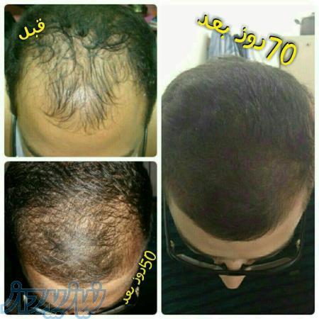 رویش مجدد مو 