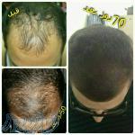 رویش مجدد مو 