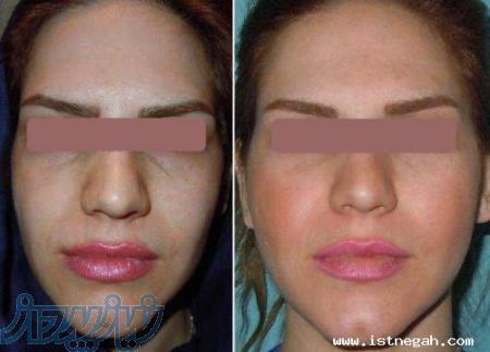 تزریق چربی گونه توسط پزشکان متخصص-کلینیک آریا 