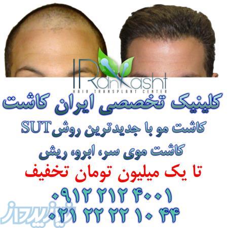 جشنواره بهاری کاشت مو 