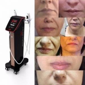 اجاره و خرید هایفو اولتراسونیک  - تهران