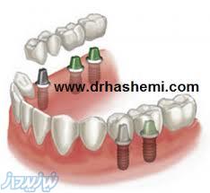 مرکز کاشت دندان ( ایمپلنت ) دکترسیداحمدرضاهاشمی 