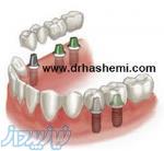 مرکز کاشت دندان ( ایمپلنت ) دکترسیداحمدرضاهاشمی 
