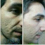 کرم از بین برنده لک و فرورفتگی صورت 