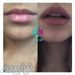 فیلر لب و بوتاکس در کلینیک آذر 